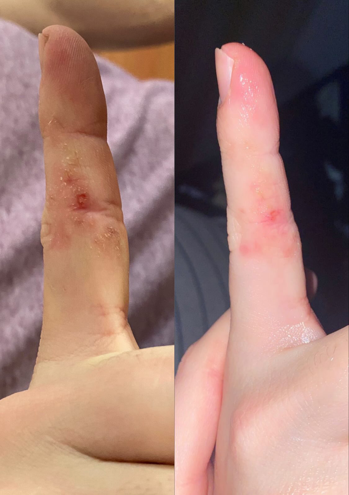 customer review on soothing balm finger with rash progress photo after use of soothing balm improvement of rash 